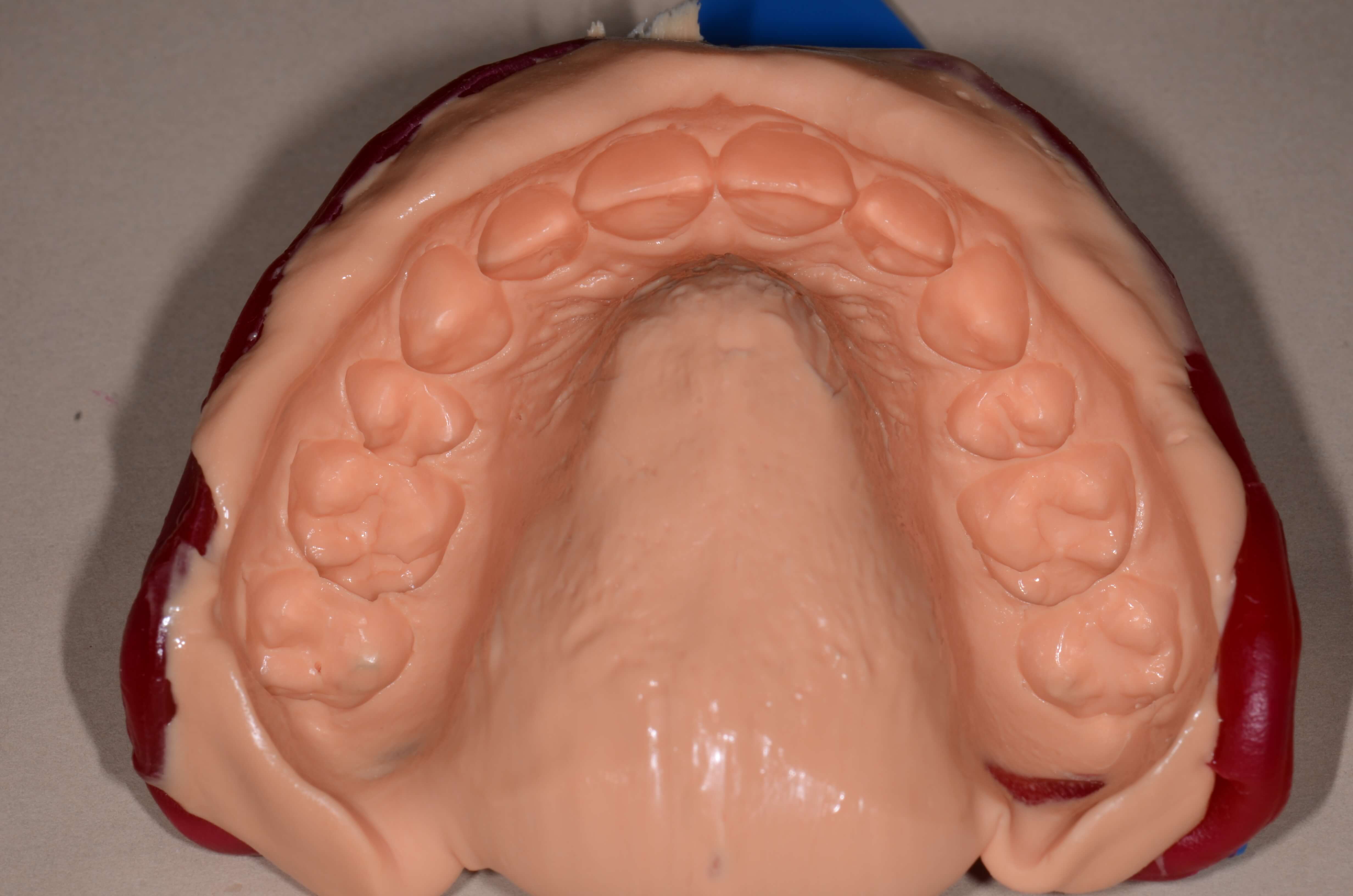 Diagnostic Impression With Xantasil Alginate Replacement Restorative
