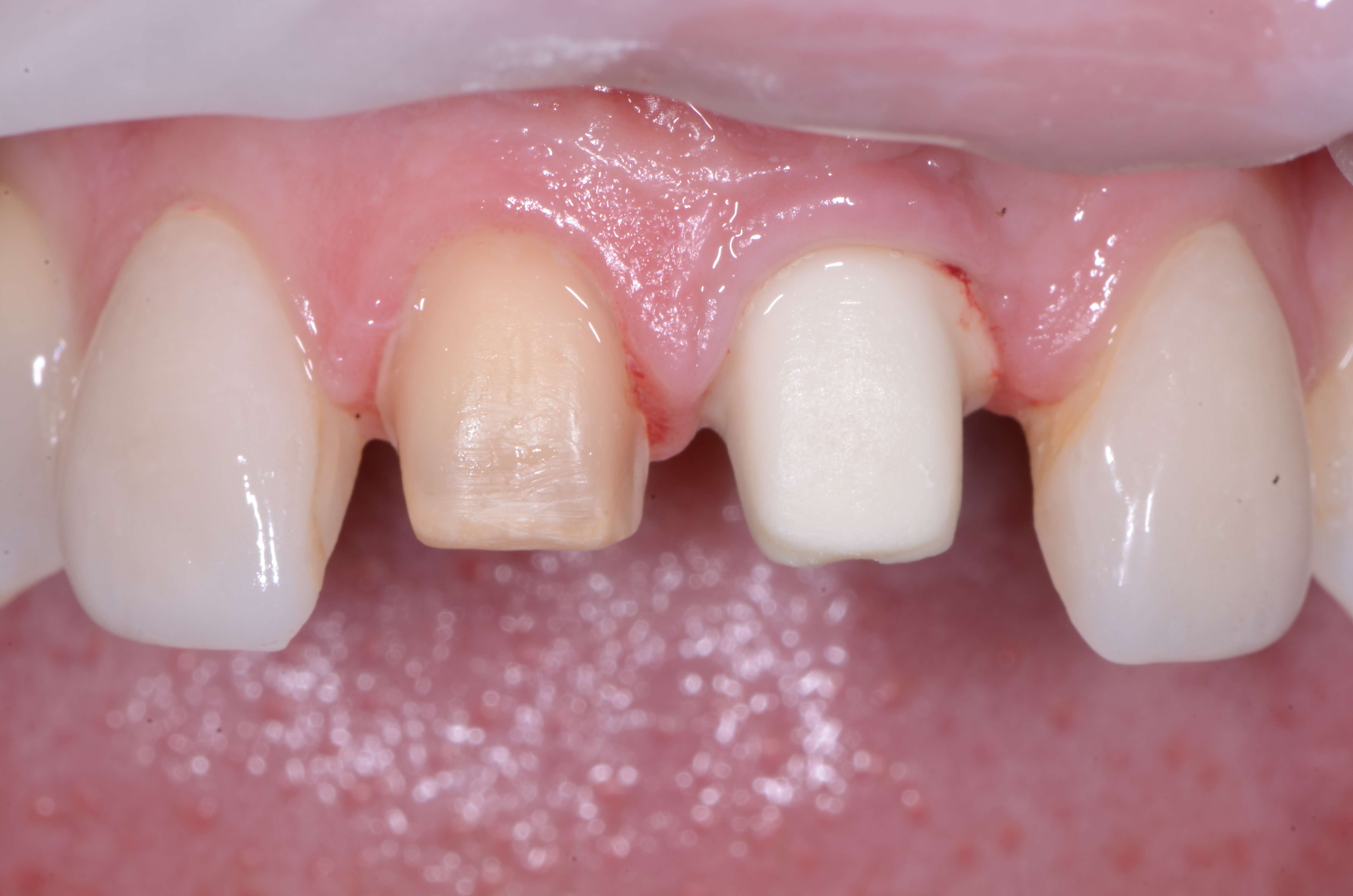 Dental Implant Abutment Material Selection Restorative Nation