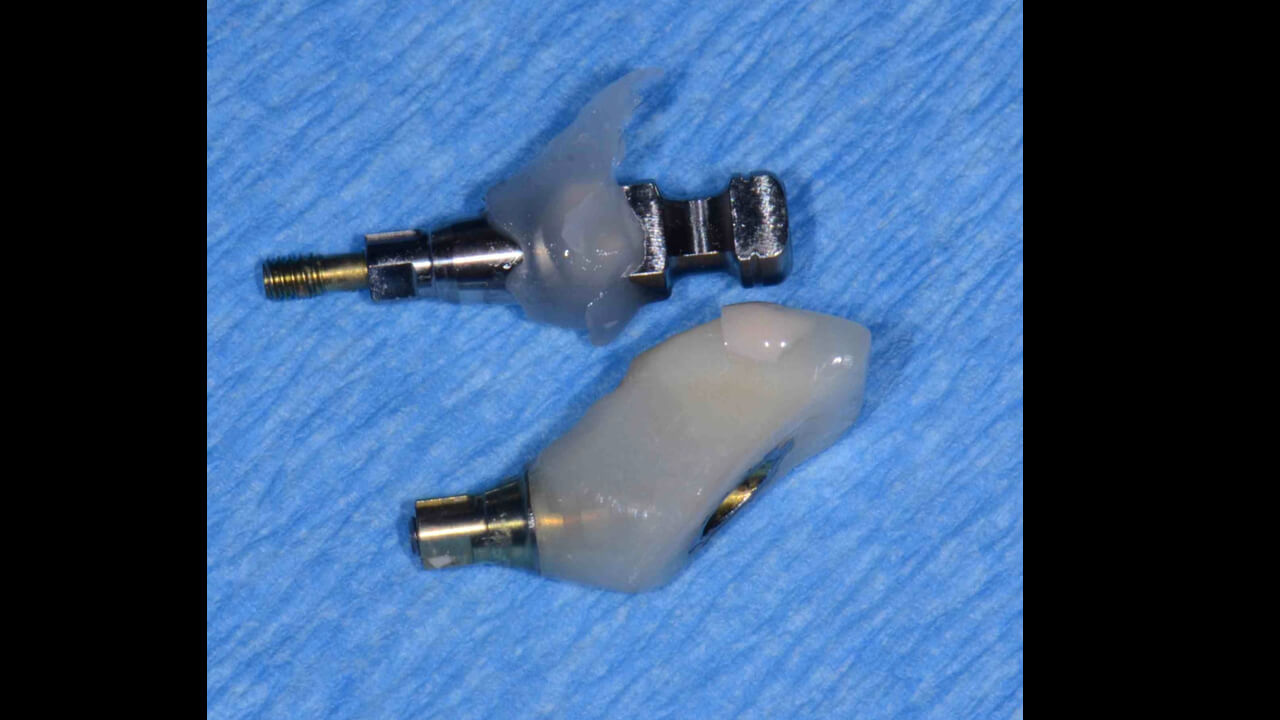 Custom Implant Impression Coping Restorative Nation