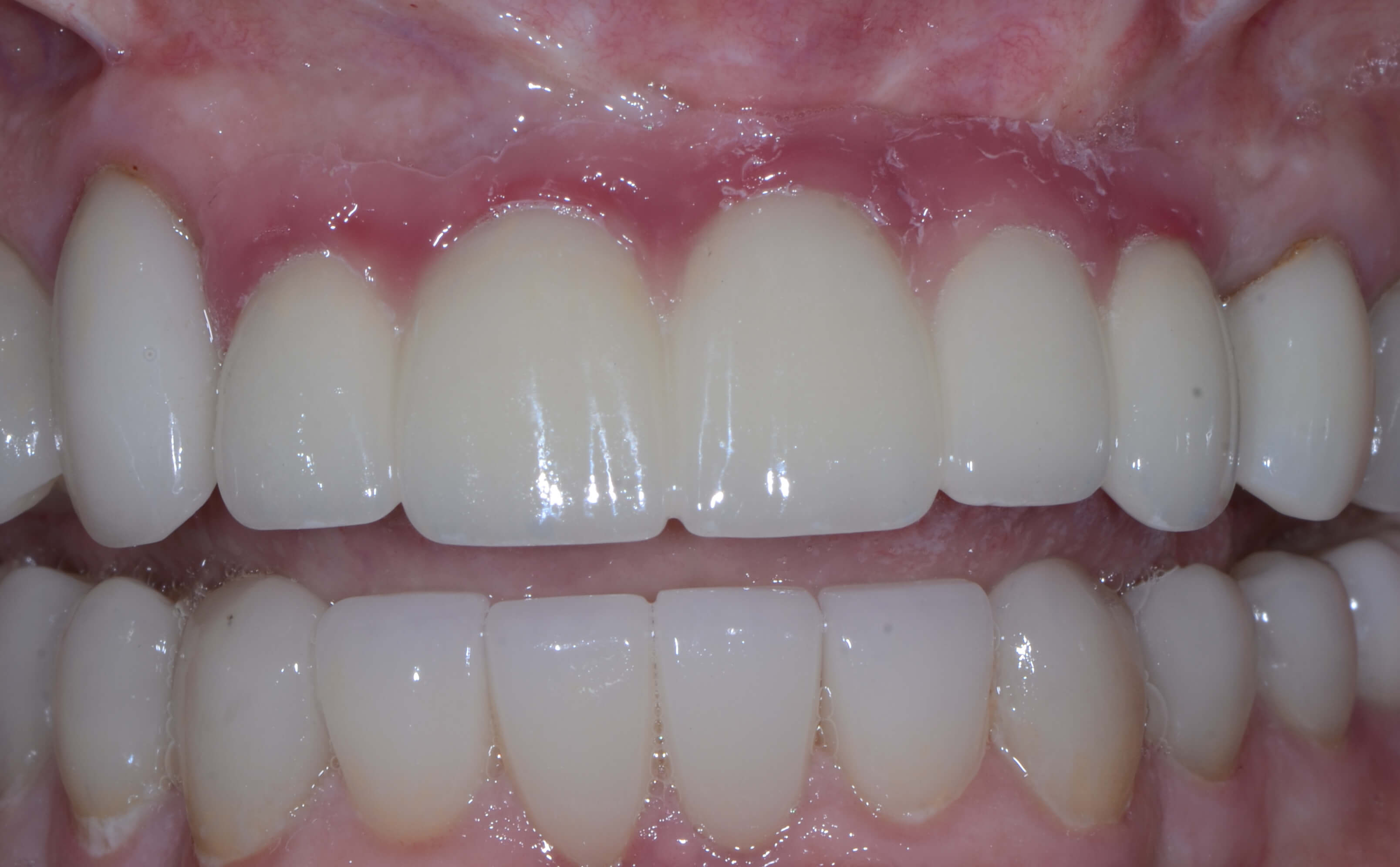 Utilizing Pink Composite for Tissue Replacement Restorative Nation
