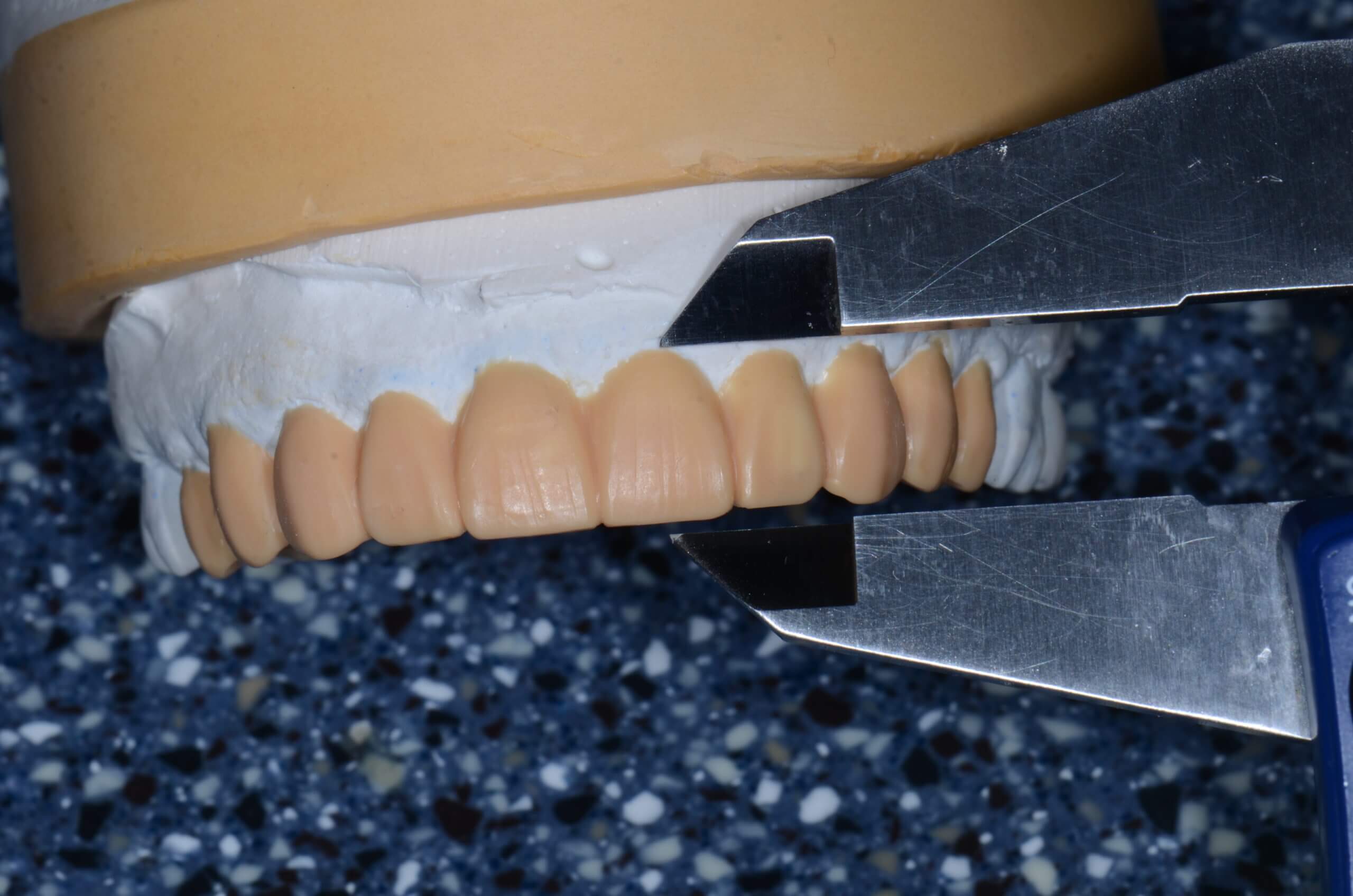 Ensuring The Accuracy of Dental Provisionals Restorative Nation