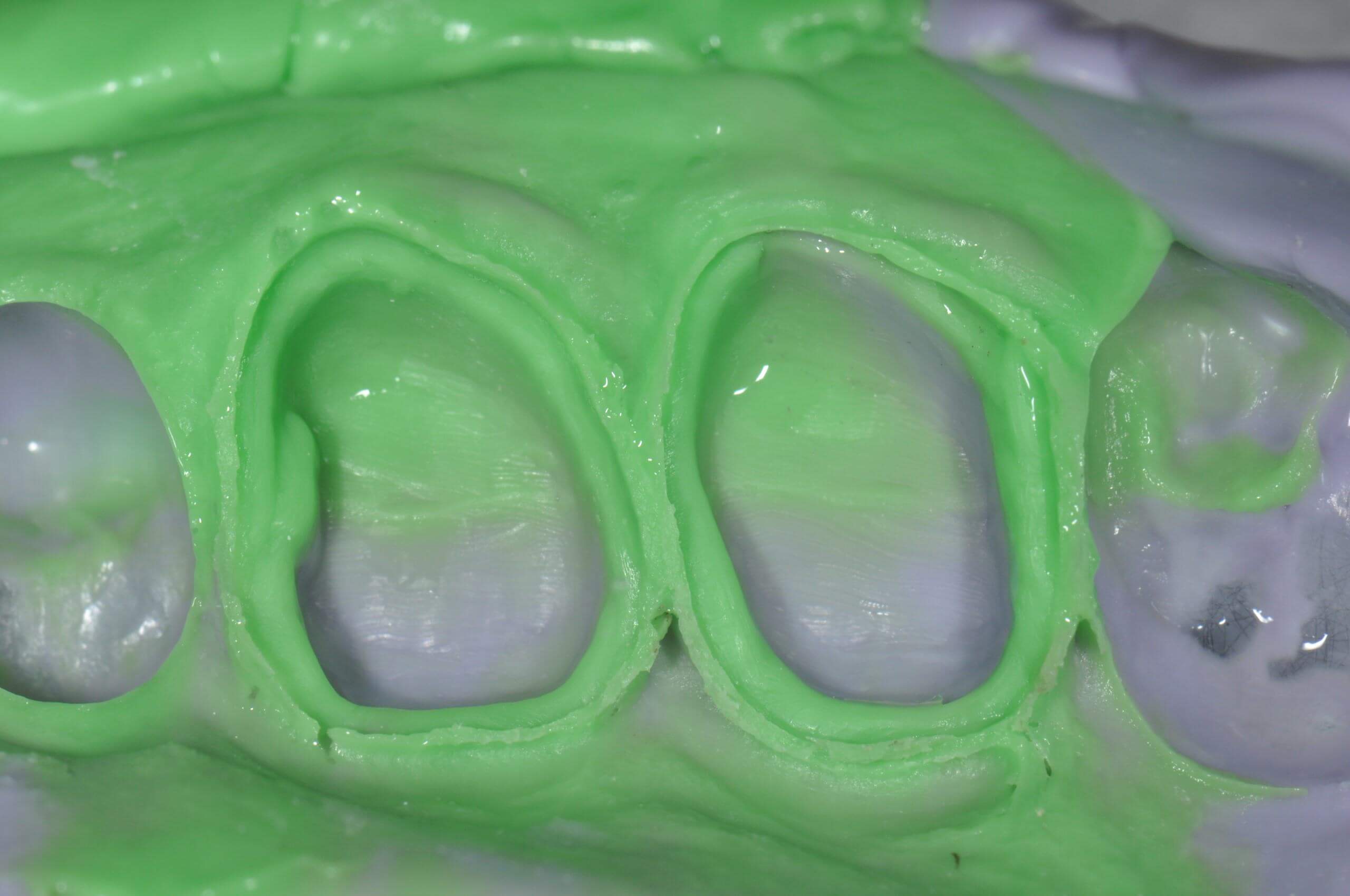 Exquisite Dental Impression Techniques Restorative Nation